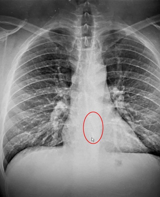 x-ray of Brad Gauthier showing the Apple AirPod in his stomach