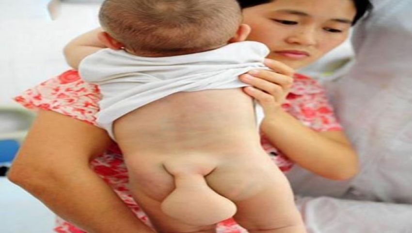 ولادة طفل صينى بذيل طوله 10سم | مصر العربية